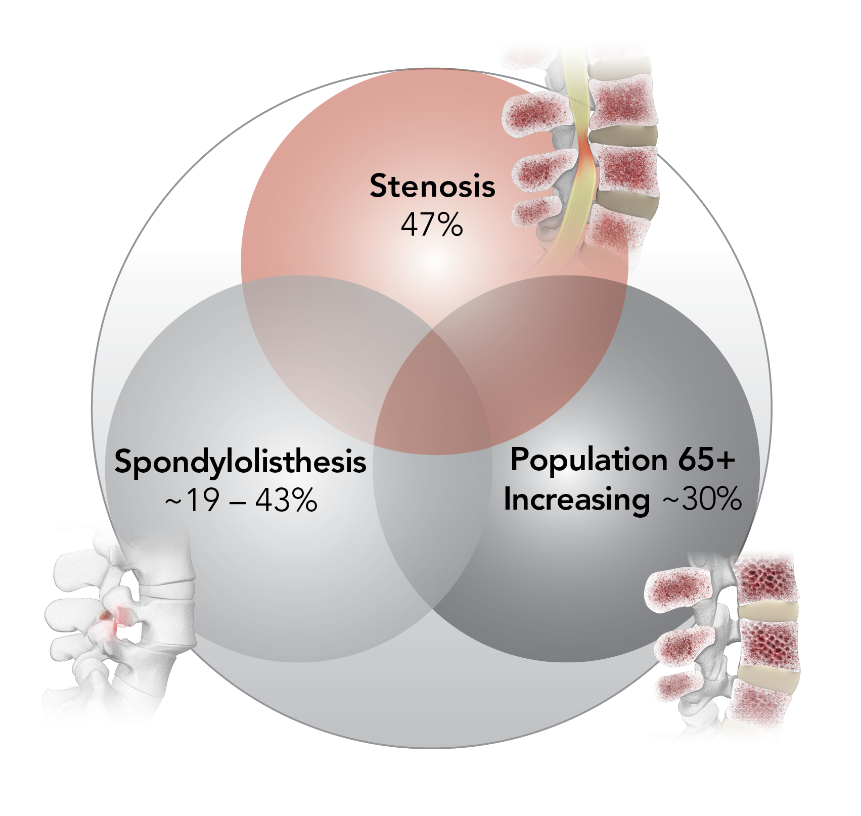 Karma Degenerative Spondylolisthesis Stenosis Venn Diagram_Spinal Elements