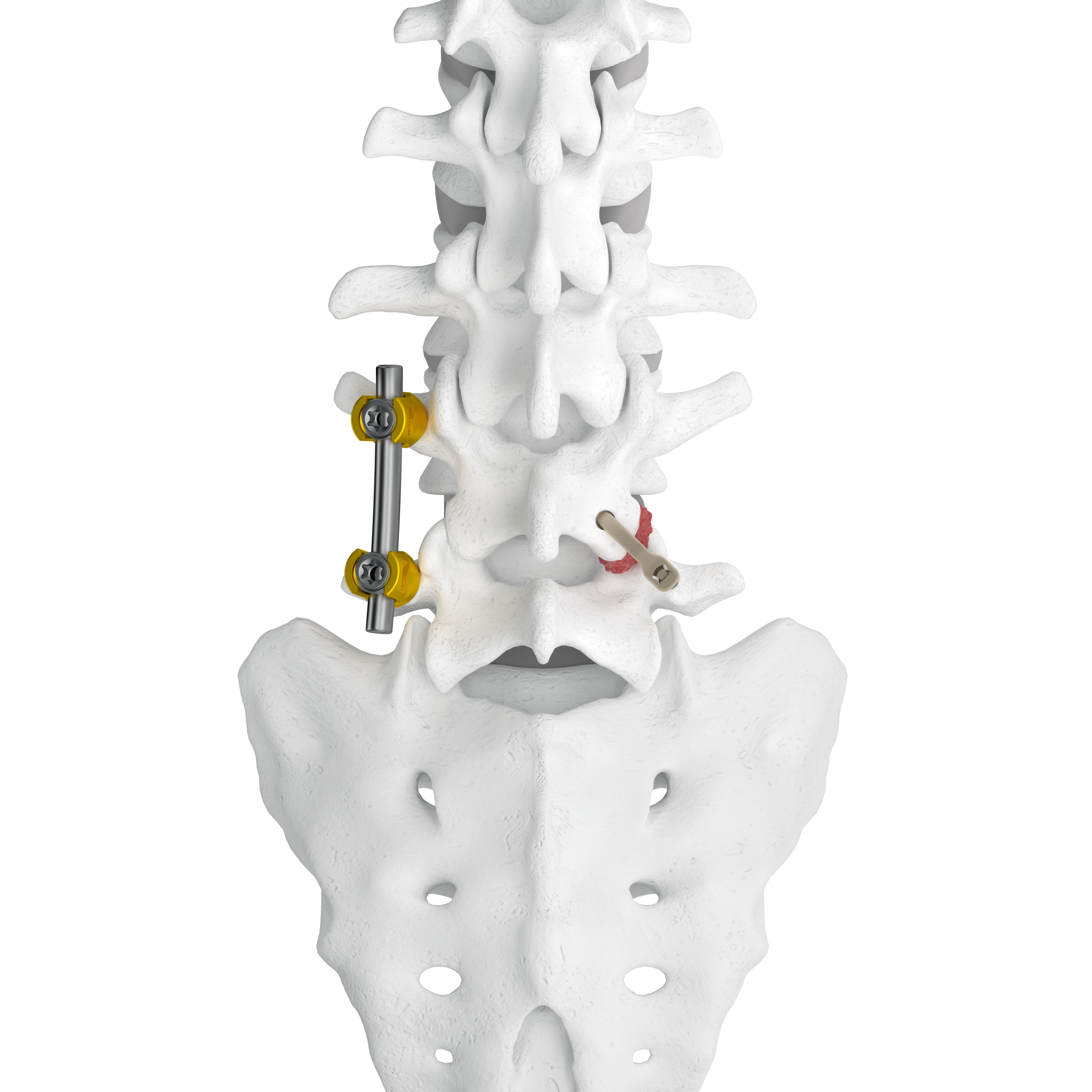 Karma on right side Rods and Screws on the left2