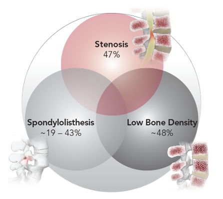 image001 (2) Karma Degenerative Spondylolisthesis Stenosis Venn Diagram_Spinal Elements